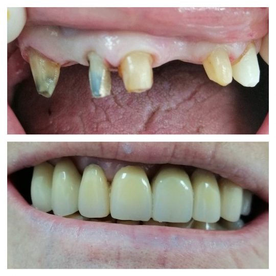 preparazione monconi per provvisori armati dentista ceo bollate