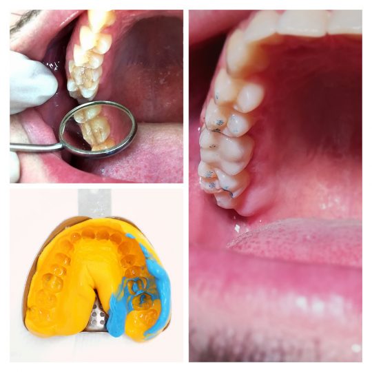 intarsio in composito dente dentista ceo bollate