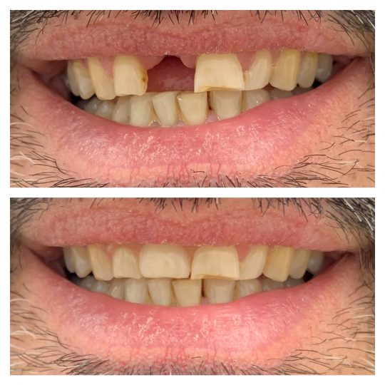 protesi mobile parziale centrale dentista ceo bollate