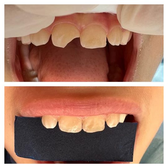 ricostruzione estetica del centrale dentista ceo bollate