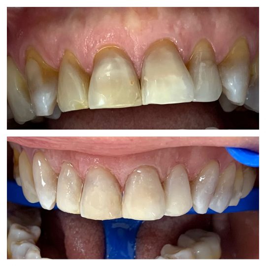 ricostruzione al colletto dentista ceo bollate