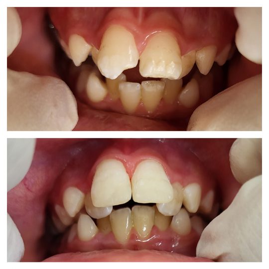 ricostruzione estetica denti ceo bollate