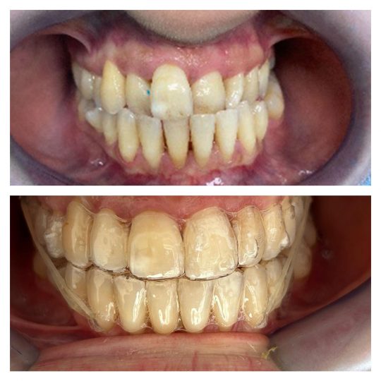 Trattamento con allineatori INVISALIGN®