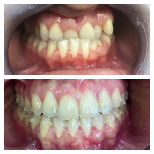Trattamento con allineatori INVISALIGN®